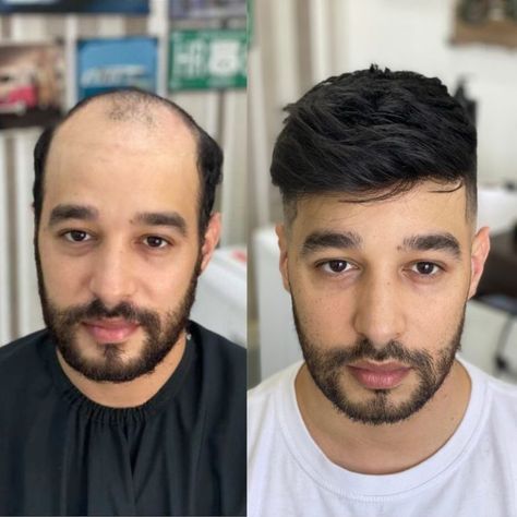 درمـان ریزش مو